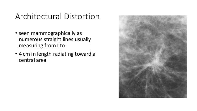 architectural breast distortion Architectural breast distortion
